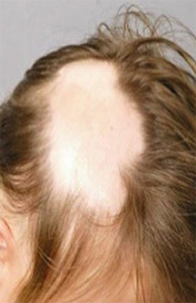 alopecia