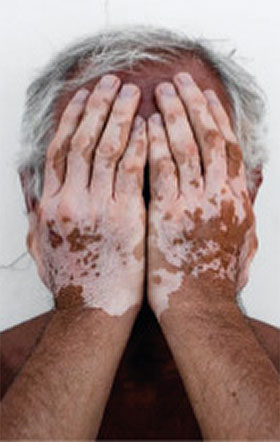 vitiligo